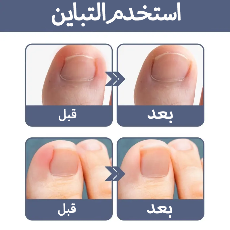 سيروم عشبي لتصحيح أظافر القدم النامية تحت الجلد