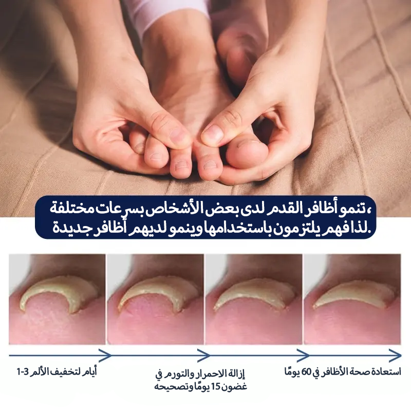 سيروم عشبي لتصحيح أظافر القدم النامية تحت الجلد
