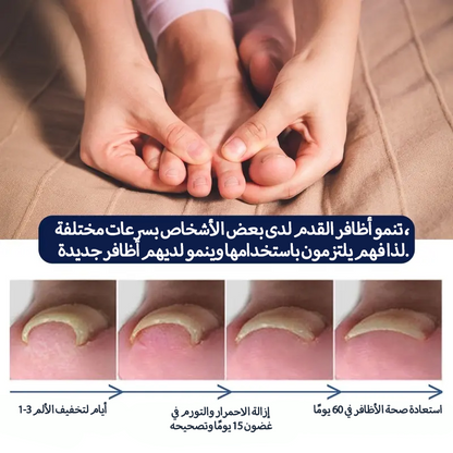 سيروم عشبي لتصحيح أظافر القدم النامية تحت الجلد