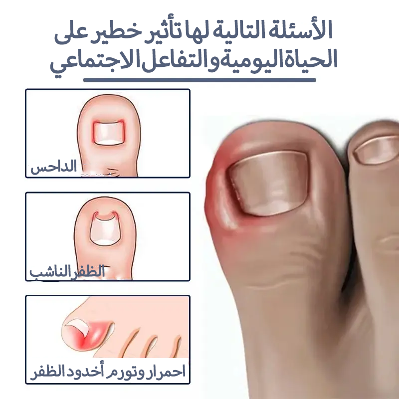 سيروم عشبي لتصحيح أظافر القدم النامية تحت الجلد