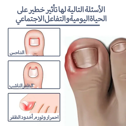سيروم عشبي لتصحيح أظافر القدم النامية تحت الجلد
