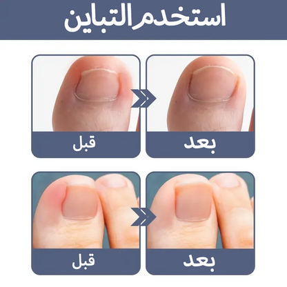 سيروم عشبي لتصحيح أظافر القدم النامية تحت الجلد